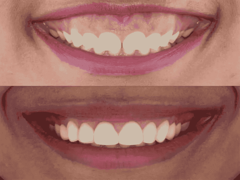 Smile Makeover in Ambattur