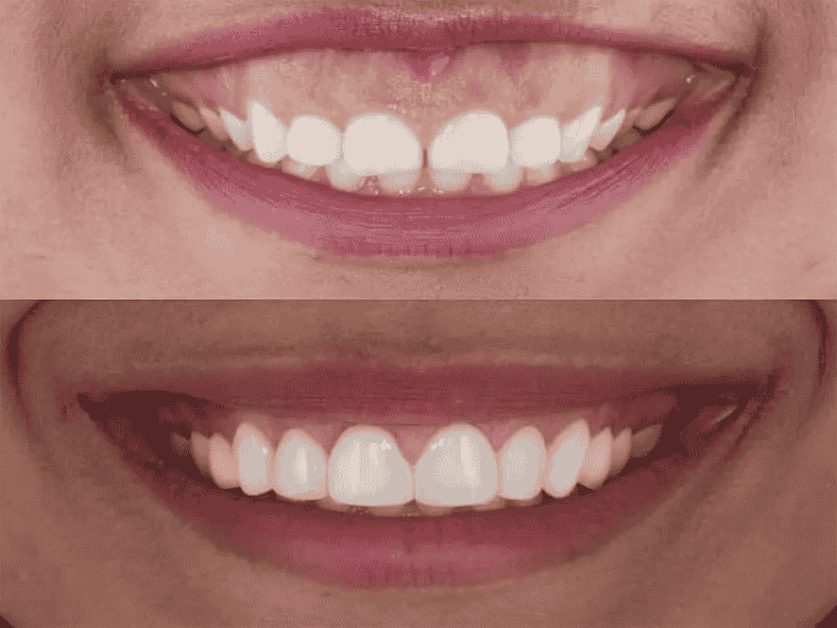 Best Smile Makeover in Ambattur | Dr. Mithun’s Dental Clinic